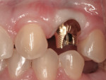 Figure 3 Custom abutments were tried in to evaluate the position and occlusal clearance.
