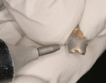 Figure 5 Silicatization of the metal abutments was performed with a micro-abrasion unit.