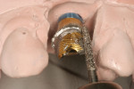 Figure 4 Abutments placed on the working model for labial and incisal aspect reduction.