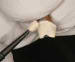 Figure 6 Several thin coats of an opaque resin that matched the shade of the prepped teeth were applied and light polymerized.
