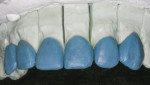 Figure 8 The proximal contours of teeth No. 7 and No. 10 were altered to create the optical illusion of a narrower tooth.
