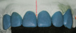 Figure 9 The proximal contours of teeth No. 7 and No. 10 were altered to create the optical illusion of a narrower tooth.