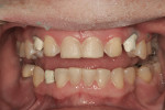 Figure 7 The four anterior teeth were then prepared for porcelain laminate veneers.