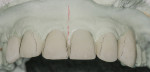 Figure 10 The mesial contour ridge of the lateral incisors was highlighted to enhance the optical illusion transforming a canine tooth into a lateral incisor, and the contours of the restorations were seen more readily by using pencil lines.