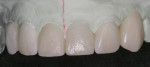 Figure 11 Incisal porcelain was added to the lingual aspect to close the incisal embrasure.