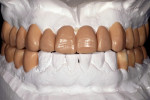 Figure 13  A diagnostic wax-up to idealize the esthetic and occlusal relationship following model surgery.