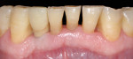 Figure 9 Final restoration after 3 months showing successful esthetic outcome.