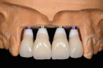 Figure 13 The surgical template was used to add the implant analogues to the master cast. Zirconia abutments were placed, and temporary restorations were fabricated for immediate delivery at the time of surgery.