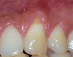 Figure 3a  The labial surface of tooth No. 11 shows 3 mm of gingival recession. Note the margin of keratinized tissue.