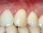 Figure 3b  There is a margin of keratinized tissue; therefore, a coronally positioned flap was used to correct the gingival recession.