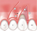 Figure 4a  Incisions for a laterally positioned graft. R-recipient tooth; D-donor tooth; A-adjacent tooth; ND-nondonor tooth; F-flap; S-split-thickness dissection; E-exposed bone or periosteum.