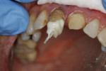 Figure 5 Unicore post is inserted, followed immediately by Fibercones and more core composite.