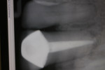 Figure 7 Postoperative radiograph revealing internal adaptation not possible with a lone prefabricated fiber post and good visibility.