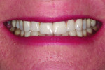 Figure 18 Post-treatment smile showing seated crowns.