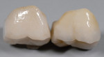 Fig 4. Comparison of stained pre-shaded ZR & transitionally shaded ZR.