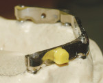 Fig 5. A 2.2-mm VKS-SG yellow matrix is snapped onto the ball.
