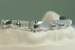 Fig 9. Completed implant bar.