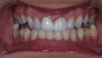 Fig 1 through Fig 3. Patient with confident e.max smile.