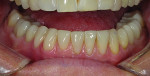 Case 1 post-treatment. Mandibular restorations included veneers and crowns following corrections to occlusion.