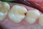 Figure 2 Case 1: Mesio-occlusal caries of primary second molar in 10-year-old patient.