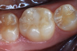 Figure 20 Mandibular molar photographed 4
months after treatment.