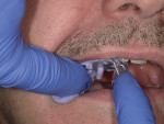 Figure 3 The tray with impression material is then inserted into the patient’s mouth in the
area to be prepared.