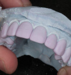 Fig 13. Crowns are seated on solid model with proper contacts and interproximal embrasures.