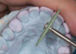 Fig 16. The lingual incisal edge is beveled with a green rubber wheel.