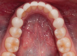 Fig 20. Lower corrected arch seated in the patient’s mouth.