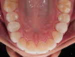 Fig 21. Upper corrected arch seated in the patient’s mouth.