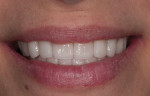 Fig 22. Patient showing a natural smile with final restorations.