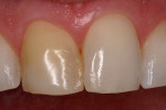 Figure 2  The discolored right central incisor.