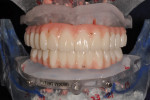 Figure 27 Maxillary and mandibular bridge with dry models.