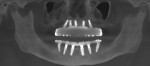 Figure 29 CBCT panoramic radiograph of completed maxillary and mandibular prosthetics.