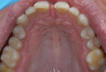 Figure 3 Preoperative photograph of the upper arch showing wear on the incisal edges.