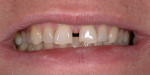 Figure 2 Preoperative close-up photograph revealing the large diastema that was the patient’s chief concern.