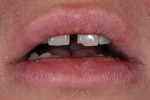 Figure 5 The amount of central incisor display in repose.