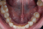 Figure 4 Preoperative photograph showing wear
on the lower central incisors.