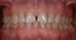 Figure 8 Maxillary tooth alignment after orthodontic treatment.