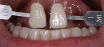 Figure 9 The incisal edges of the lower anterior teeth have been contoured and whitened.