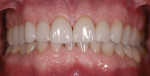 Figure 10 The teeth in maximum intercuspation after treatment showing the pleasing anterior tooth sizes achieved through orthodontic positioning.