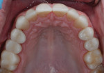 Figure 11 All maxillary teeth restored.