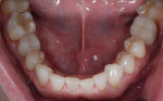 Figure 12 All mandibular teeth restored.