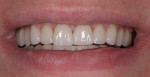 Figure 13 The upper and lower anterior teeth were harmonious after treatment.