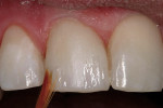 Figure 13  A violet tint was applied to tooth.