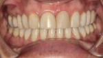 Case 2 pretreatment; patient desired a natural-looking whiter smile.