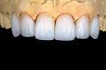 Material selection and shading reflect the need for translucency, texture, and the ability to blend into the existing dentition and gingiva.