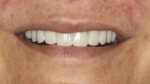 Final result showing whiter, natural-looking smile.