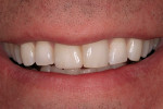 Figure 24  The postoperative smile at the 6-month recall.