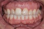 Close-up view of the patient’s anterior maxillary dentition following completion of orthodontics, periodontal treatment, and implant placement, but prior to initiating definitive restorative treatment.